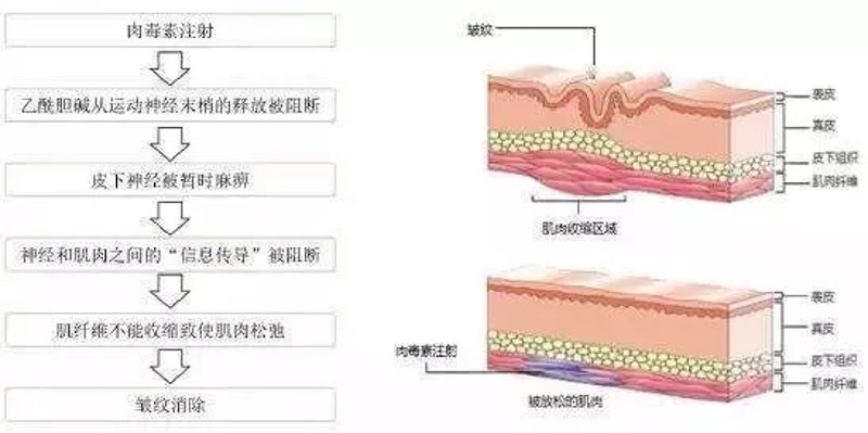 肉毒素除皱