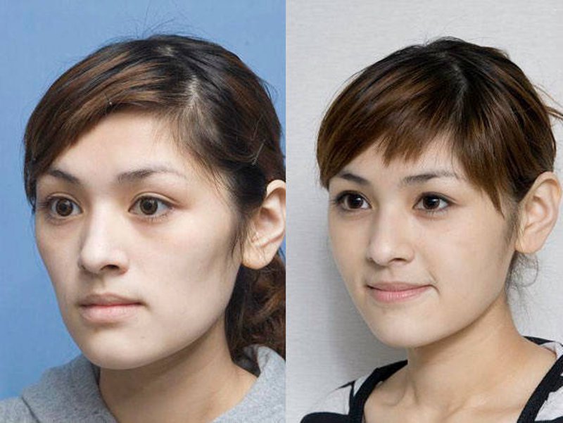 自体脂肪填充